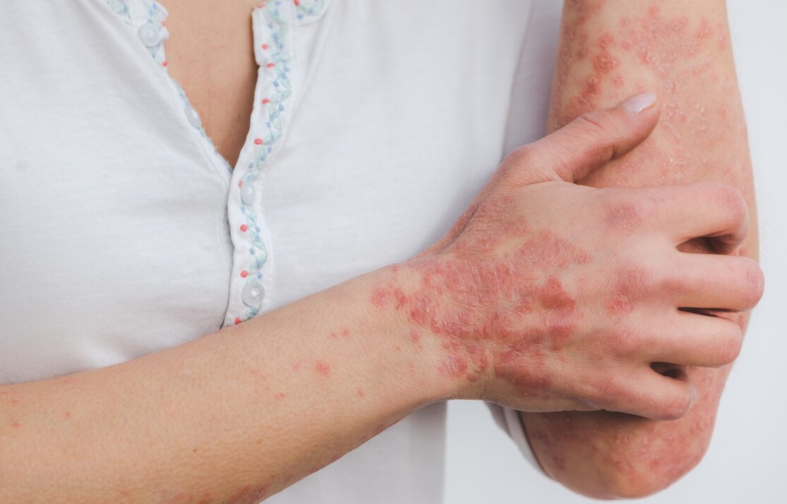 Dermatitis inflamación de la piel