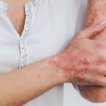 Dermatitis inflamación de la piel