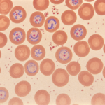 Mecanismos biológicos de la malaria: enfermedad milenaria